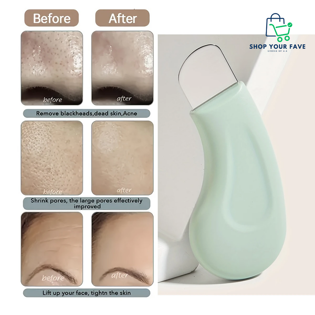 Blackhead and Whitehead Remover